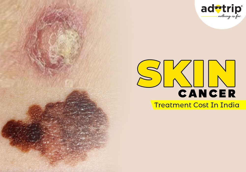 skin cancer treatment cost in india